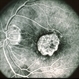Central areolar atrophy Central areolar atrophy